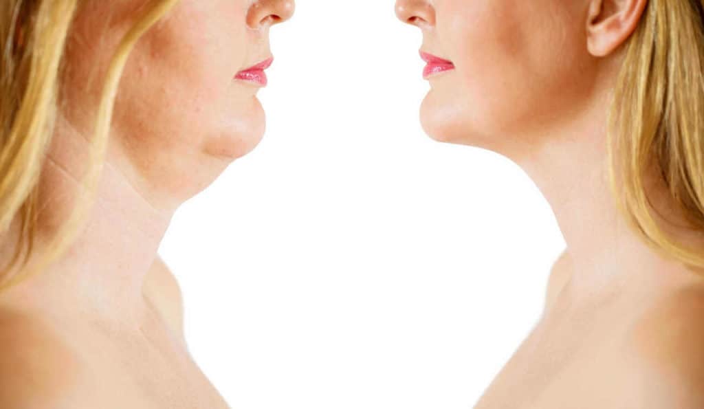 Double Chin treatment Mill Hill before and after results