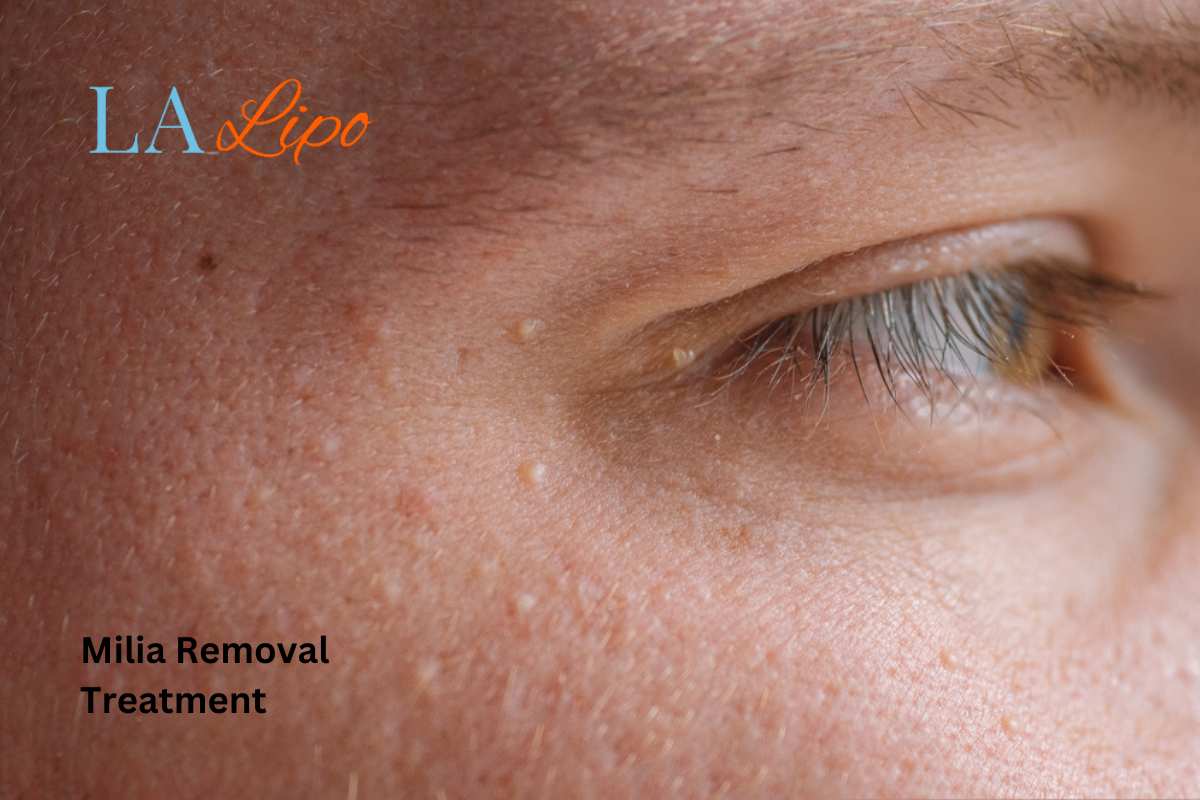 Cryopen Milia Removal: Is It the Easiest and Safest Option Mill Hill?