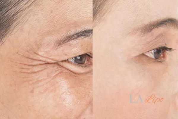 Before and after results of woman - HI-fu wrinkles reduction treatment Mill Hill