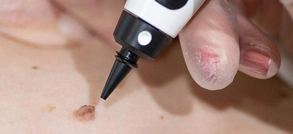 skin tag removal using cryopen Mill Hill