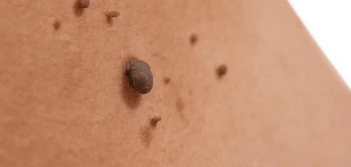 image of a skin tag Mill Hill