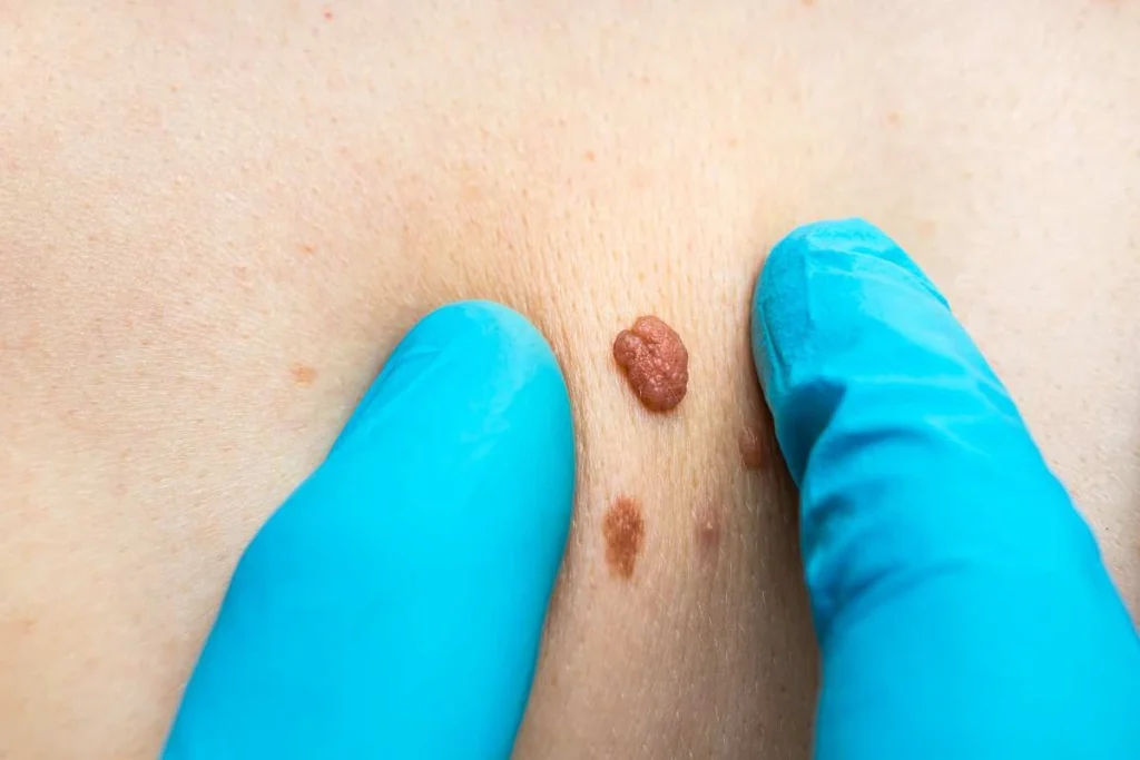Consultant examining a skin tag Mill Hill