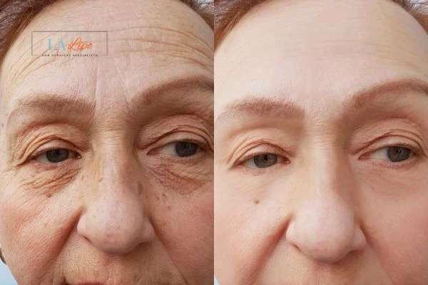 The powerful benefits of Morpheus8 Treatment Mill Hill - Call Our team today!