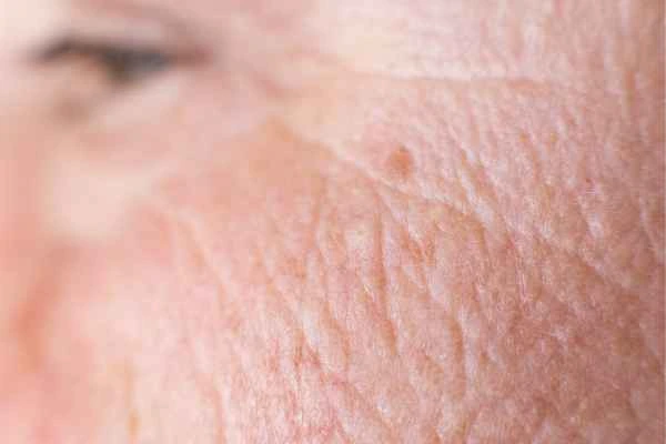 close up picture of a woman's face showing an age spot Mill Hill